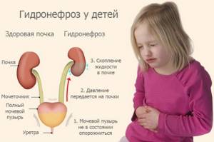гидронефроз почки симптомы лечение у детей
