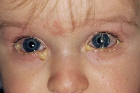 гонорея у детей симптомы и лечение