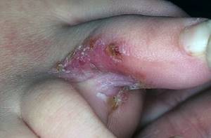 грибковые заболевания кожи симптомы и лечение на ногах