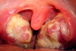 грибок горла симптомы лечение у детей