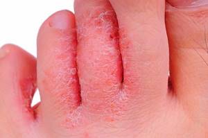 грибок кожи на ногах симптомы и лечение