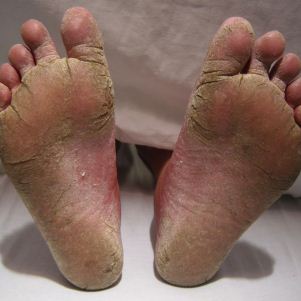 грибок на ногах симптомы и лечение мази