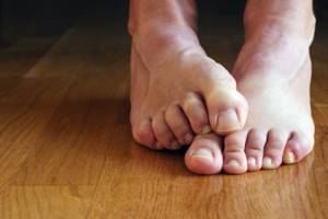 грибок на ногах симптомы и лечение в домашних условиях