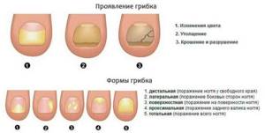 грибок ногтей на ногах начальная стадия симптомы и лечение
