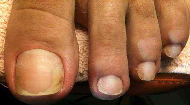 грибок ногтей на ногах симптомы лечение народными средствами