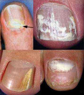 грибок ногтей на ногах симптомы лечение народными средствами