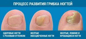 грибок ногтей на ногах симптомы лечение в домашних условиях