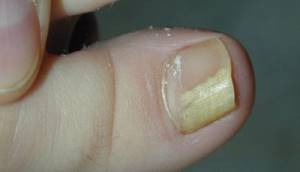 грибок ногтей на ногах симптомы причины лечение