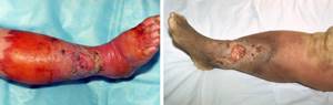 хроническое рожистое воспаление ноги симптомы и лечение