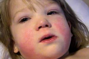 имуномононуклеоз у детей симптомы и лечение