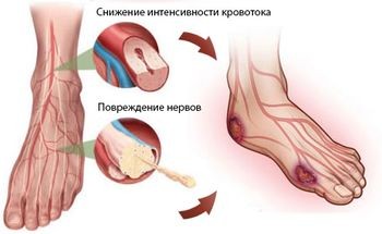 интоксикация при гангрене ноги симптомы и лечение