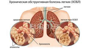 кашель у курильщика симптомы и лечение