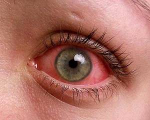 красные глаза у ребенка причины симптомы заболеваний и методы лечения