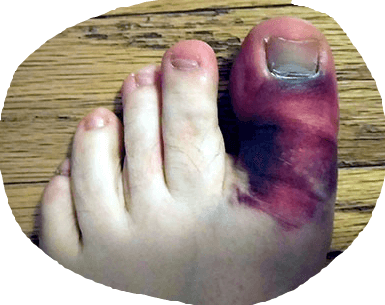 лечение перелом пальца ноги симптомы и лечение в домашних условиях