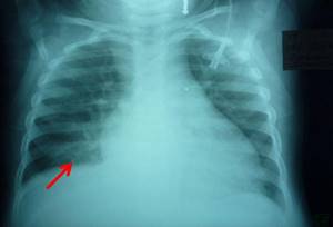 мелкоочаговая пневмония у детей симптомы лечение