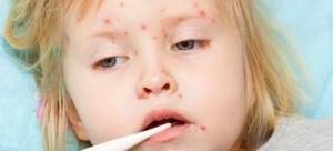 менингококковая инфекция симптомы у детей лечение