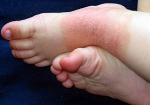 нейродермит симптомы и лечение на ногах у детей