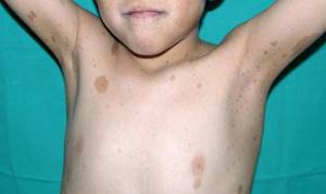 нейрофиброматоз у детей симптомы лечение комаровский