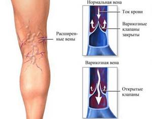 осложнения варикозное расширение вен на ногах симптомы и лечение