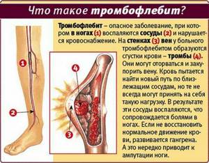 осложнения варикозное расширение вен на ногах симптомы и лечение