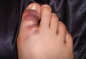 перелом на пальце ноги симптомы и лечение в домашних условиях