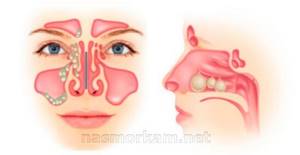 полипы в носу у ребенка симптомы лечение народными средствами