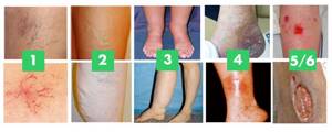причины варикозное расширение вен на ногах симптомы и лечение