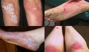 псориаз на ногах симптомы и лечение
