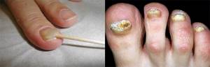 псориаз ногтей на ногах симптомы лечение