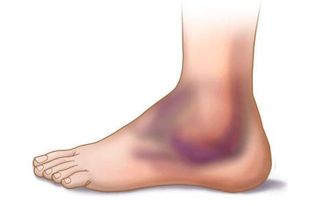 растяжение мышц ноги симптомы и лечение