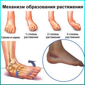 растяжение ноги симптомы и лечение