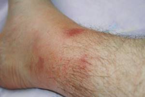 рожистое воспаление ноги симптомы и лечение мази