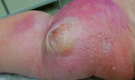 рожистое воспаление ноги симптомы и лечение слоновость