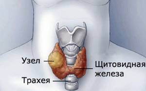 щитовидка у детей симптомы и лечение