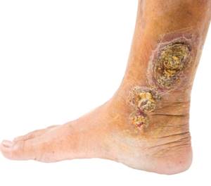 сеточка вен на ногах симптомы и лечение