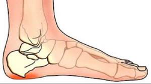 шипы на большом пальце ноги симптомы и лечение