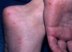 симптом рука нога рот лечение