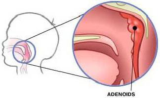 симптомы и лечение аденоидита у детей