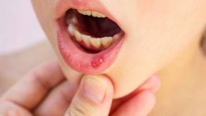 симптомы стоматита и лечение у детей