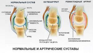 суставная боль в ногах симптомы и лечение в картинках