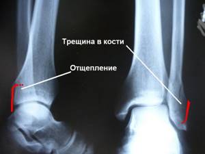 трещина кости ноги симптомы лечение