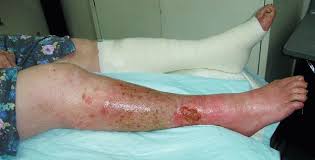 трофическая язва ноги симптомы и лечение в домашних условиях
