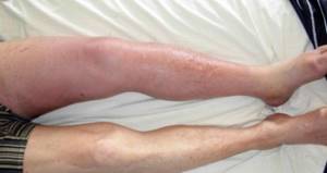 тромб вен на ногах симптомы и лечение