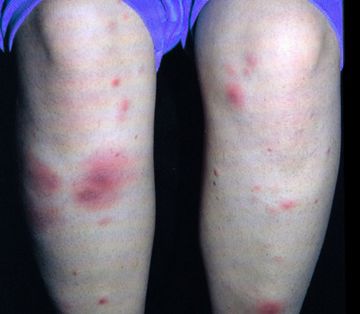 узловатая эритема на ногах при беременности симптомы и лечение