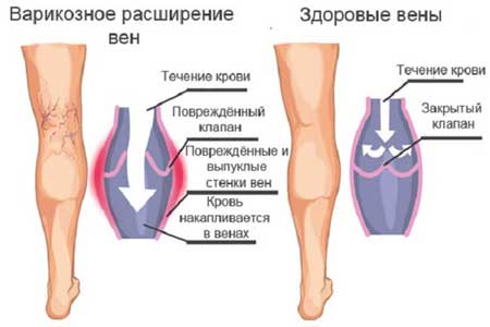 варикоз на ногах причины симптомы и лечение у мужчин