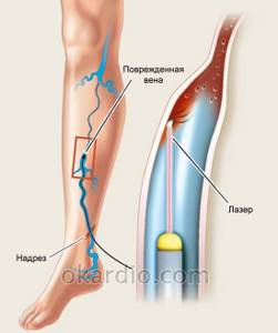 варикоз на ногах у мужчин причины симптомы лечение