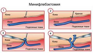 варикоз на ногах у мужчин причины симптомы лечение