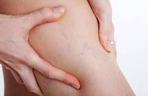 варикоз на ногах у женщин лечение симптомы