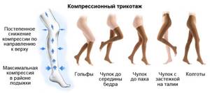 варикоз на ногах у женщин симптомы и лечение