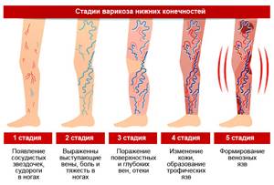 варикоз на ногах у женщин симптомы и лечение